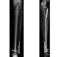 Expert Titanium Cannulated Tibial Nail with Proximal Bend