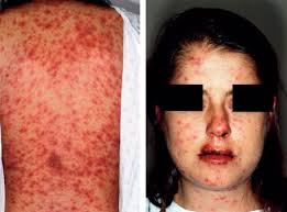 N engl j med 1995; Clinical Etiologic And Histopathologic Features Of Stevens Johnson Syndrome During An 8 Year Period At Mayo Clinic Sciencedirect