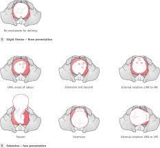 Image result for Manual Rotation in Occipitoposterior Presentation