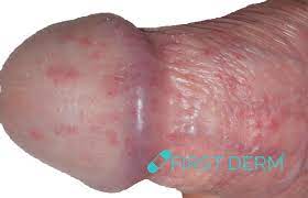 Roter Hautausschlag Am Penis Bilder Symptome Diagnose Und Behandlung