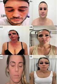 a) Face atopic dermatitis with periorbital eczema in patient treated...