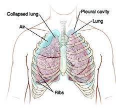 If you have signs or symptoms of a collapsed lung, such as chest pain or trouble breathing, get medical care right away. Pneumothorax Spontaneous