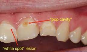 Tooth Filling Procedure Cost Cavity Filling Types Nearby Dental