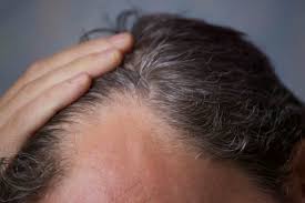 Yes, there are a couple of products on the market that will help some men grow some hair. My Receding Hairline Is Re Growing After Just 12 Days Of Natural Treatment Weku