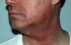 It may also been found in textile or fur dyes, dark coloured cosmetics, temporary tattoos, photographic developer and lithography plates, photocopying and printing inks, black rubber, oils. Allergie Voor Cosmetica Huidarts Com