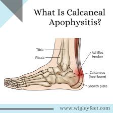 Image result for Calcaneal Apophysitis
