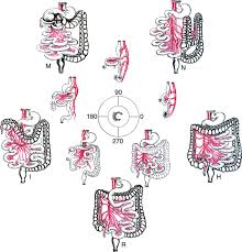 Image result for Intestinal Malrotation