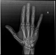 Aneurysmal Bone Cyst Radiology Case Radiopaedia Org Hand Therapy Cysts Radiology