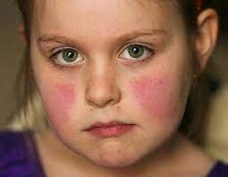 La quinta malattia è contagiosa solo nei giorni immediatamente precedenti alla comparsa dell'eruzione, quindi ancor prima che si la quinta malattia non richiede farmaci, perché guarisce da sé. Quinta Malattia Sintomi Come Riconoscerla Incubazione E Contagio Foto Greenme
