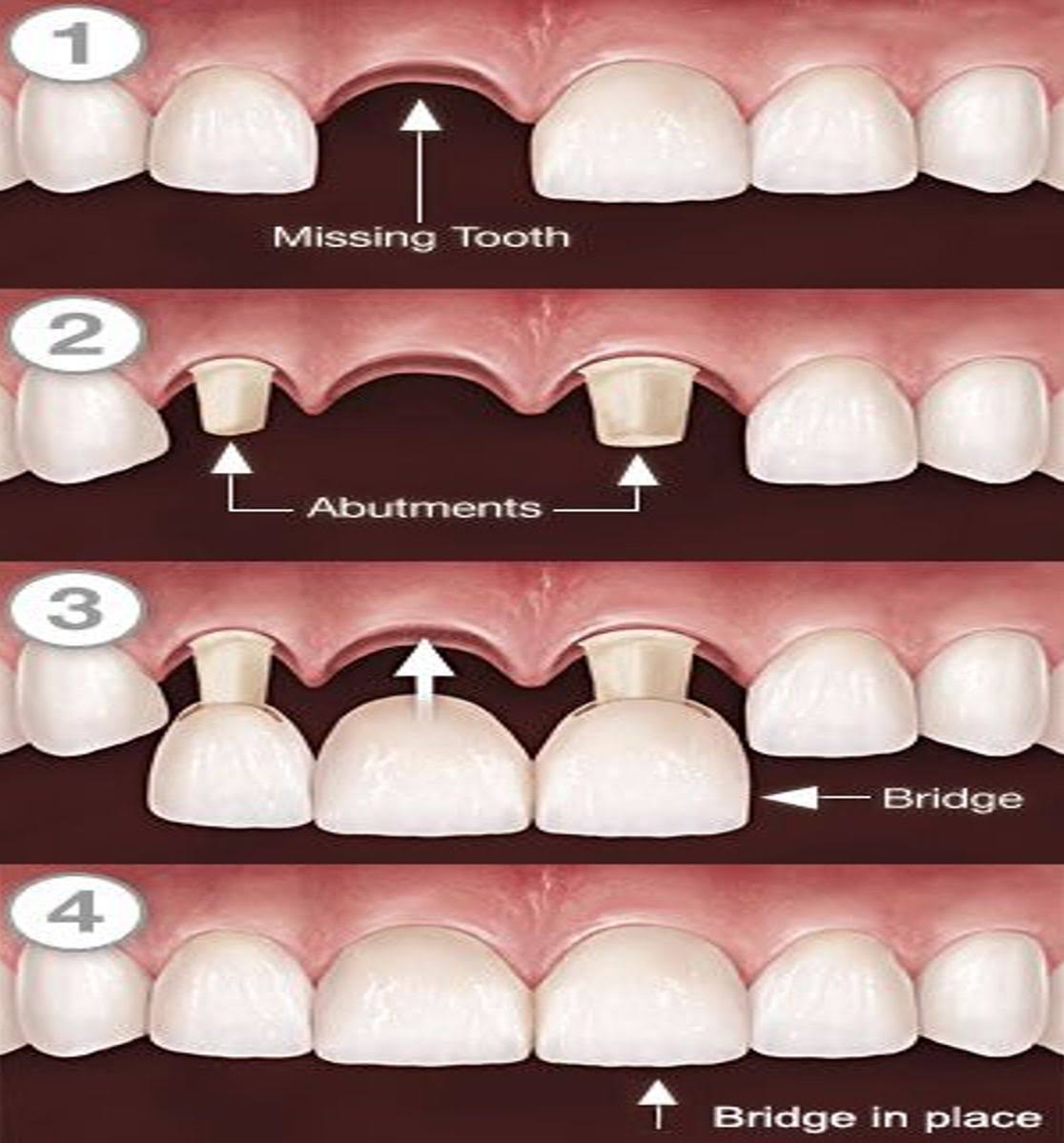 Crowns & Bridges Treatment in Sus, Pune product image