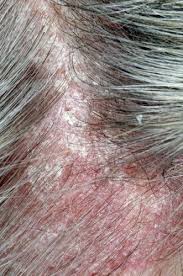 A psoríase no couro cabeludo provoca sintomas como: Image Psoriase Do Couro Cabeludo Manual Msd Versao Saude Para A Familia