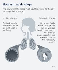 An asthma attack is not something that just goes away, so you really do have to get them to proper medical care right now when it happens. Asthma When Breathing Becomes Difficult Science In Depth Reporting On Science And Technology Dw 07 05 2019