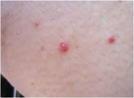 Essential oils and avoiding certain toxins are part of cherry angioma home remedies. Cherry Angioma Women S Health