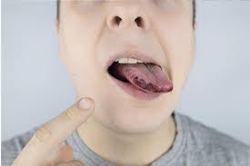 Image result for black tongue symptoms