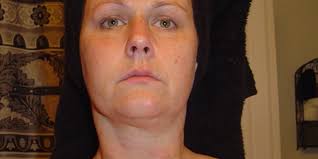 Asthma drug can ease agony of constant itch, too