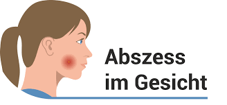 Meine stute hat unter der haut so kleine und große knubbel, die nicht aufgehen bzw. Abszess Hausmittel Abszess Offnen Abszesswunde Pflegen Medica Apotheke Kiel