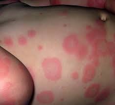 Image result for Erythema Multiforme Major