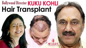 Bollywood Director Celebrity Kuku Kohli Shares Hair Transplant Experience With Dr Suneet Soni In 2020 Hair Transplant Medispa Hair Transplant Cost