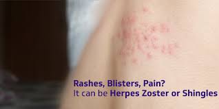 Adapted by dr adrian m bonsall, from the paediatric handbook 6th ed. Rashes Blisters Pain It Can Be Herpes Zoster Or Shingles Rxdx Healthcare