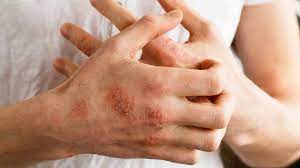 Pin By Anika Bose On Health Eczema Treatment Eczema Severe Eczema