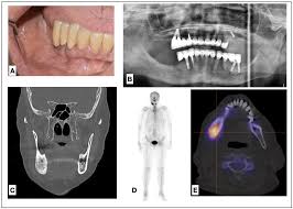 Image result for Osteomyelitis