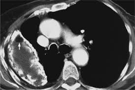 Although pleural effusions are often easily identified on computed tomography (ct), trace on ct, pleural thickening may be difficult to distinguish from an effusion. Pleura Chest Wall And Diaphragm Thoracic Key