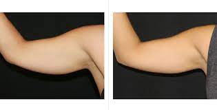 It is a suitable procedure for those who are at their ideal weight but wish to eradicate stubborn deposits of fat. Coolsculpting For Arms Procedure Cost Side Effects And Photos