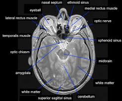 Paranasal Sinus Cancer