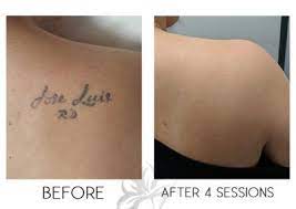 Laser Tattoo Removal Quanta Q Plus C Name Complete Tattoo Removal Tattoos Laser Tattoo
