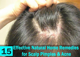 15 Effective Natural Home Remedies For Scalp Pimples Acne Pimples On Scalp Sores On Scalp Scalp Acne