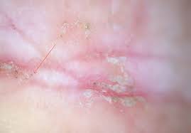 Image result for scabies in the groin area