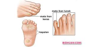 Cukup dengan satu sendok teh. Penyakit Mata Ikan Penyebab Gejalanya Dan Cara Mengobatinya Berbagi Cerita Opini Edukasi Dan Hiburan