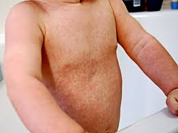 Rubella or German measles in children ...