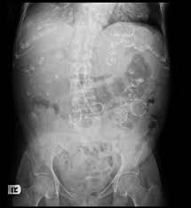 Autosomal Dominant Polycystic Kidney Disease Radiology Case Radiopaedia Org Polycystic Kidney Disease Renal Disease Kidney Disease
