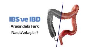 Şerafettin özer, ülseratif kolit ve crohn hastalığına dair önemli değerlendirmelerde bulundu. Irritabl Bagirsak Sendromu Ibs Ve Inflamatuar Bagirsak Hastaligi Ibd Arasindaki Farklar Nelerdir Prof Dr Sezai Leventoglu