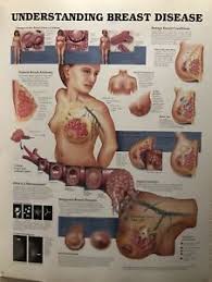 Details About Understanding Breast Cancer Anatomy Poster Medical Chart