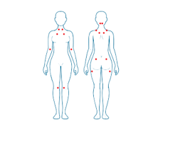 Estudio de las causas de fibromialgia y causas de los daños factores que pueden subyacer bajo el la fibromialgia es una enfermedad que cursa con dolor espontáneo generalizado, fatiga crónica. Fibromialgia Que Es Sintomas Diagnostico Y Tratamiento