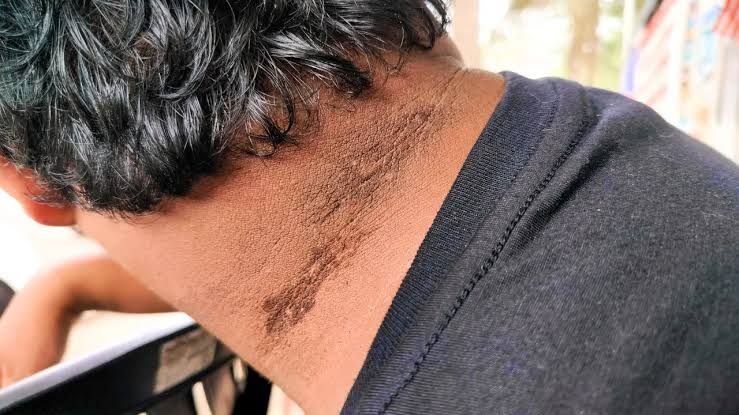Dark Spots On Neck? Acanthosis Nigricans Causes & Treatment