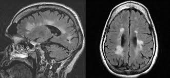 May 11, 2021 · multiple sclerosis (ms) is a chronic condition involving your central nervous system (cns). D 6kvcdsh48ksm
