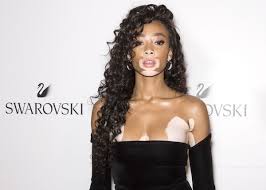 Black And White Skin Condition Model Model With Vitiligo Gets Casted To Walk In Victoria S Secret 2018 Fashion Show Vitiligo Model Vitiligo Vitiligo Cure