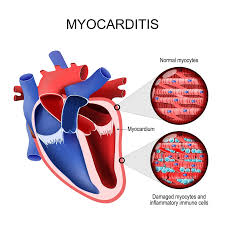 Image result for Myocarditis