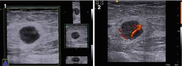 A breast ultrasound is most often done to find out if a problem found by a mammogram or physical this is because it may miss some early signs of cancer. Ultrasound Of Male Breast Cancer Radiology Key
