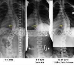 Pin On Scoliosis