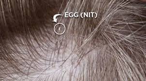 If a heat dryer is used during the bleaching process the extreme temperature could kill some of the lice and nits but it is unlikely that it would kill an entire infestation. What Are Nits What Do They Look Like The Lice Removal Clinic
