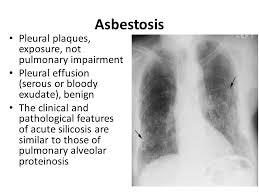 Asbestos produces the following lung disorders: Environmental Lung Disease Ppt Video Online Download