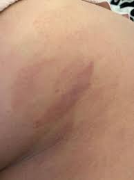 Even though you can use various chemical treatments to get rid of bruises, applying natural treatments might help you in. A Bunch Of Painless Bruises On Butt December 2020 Babies Forums What To Expect