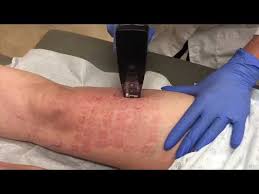 Evolve tattoo removal san diego. Morpheus8 San Diego Dr Susan Kaweski