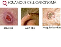 Here&#x27;s what we know so far. Types Midwest Dermatology Midwest Dermatology
