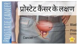 Cancer symptoms can vary and are often mistaken for other conditions. Nota Bene Cancer Prostate Cancer Symptoms In Hindi