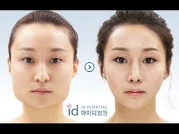 Korelilerin Estetik Ameliyati Oncesi Ve Sonrasi Korean Plastic Surgery Before After Youtube